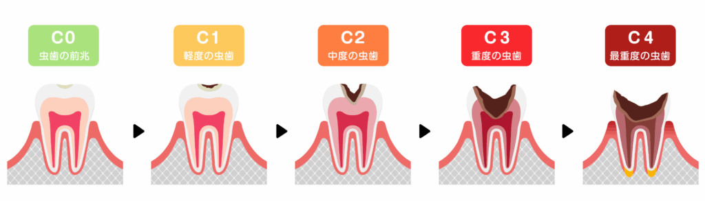 虫歯の進行|RISEI
