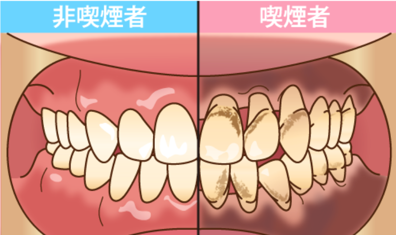 喫煙による影響|RISEI