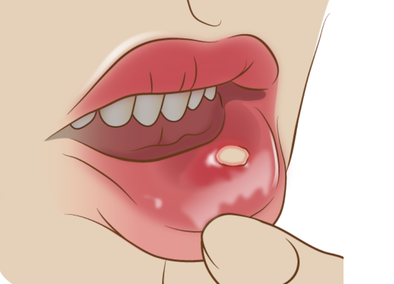 嚢胞(のうほう)・良性腫瘍の摘出|RISEI