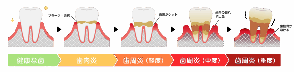 歯周病の進行|RISEI
